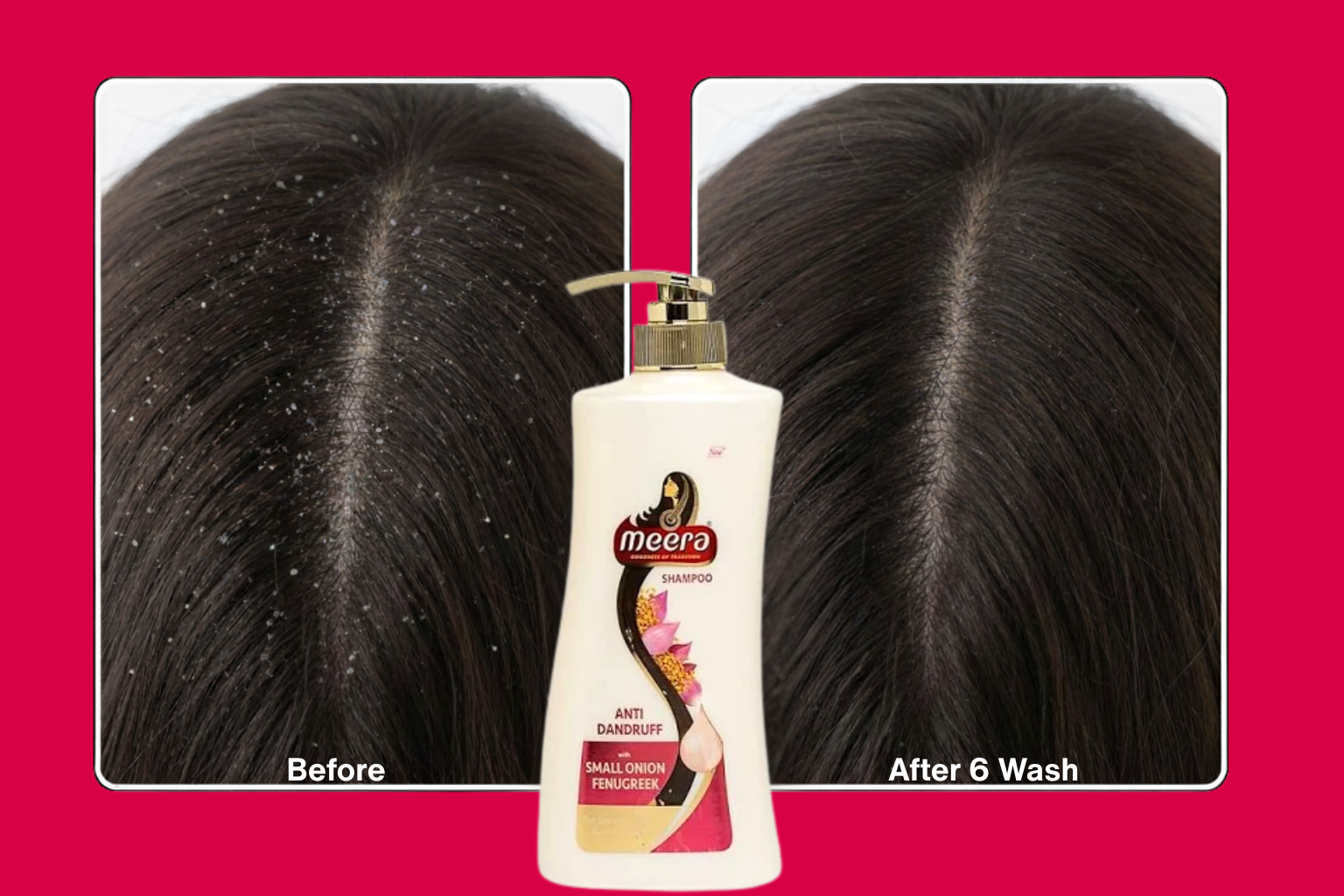 Dandruff: Understanding Its Causes and How to Treat It with Natural Ingredients