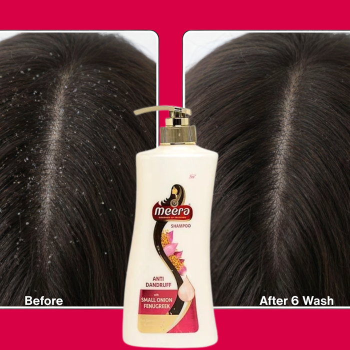 Dandruff: Understanding Its Causes and How to Treat It with Natural Ingredients