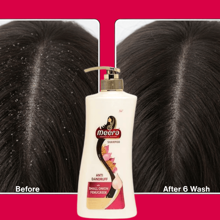 Dandruff: Understanding Its Causes and How to Treat It with Natural Ingredients - Cavinkart