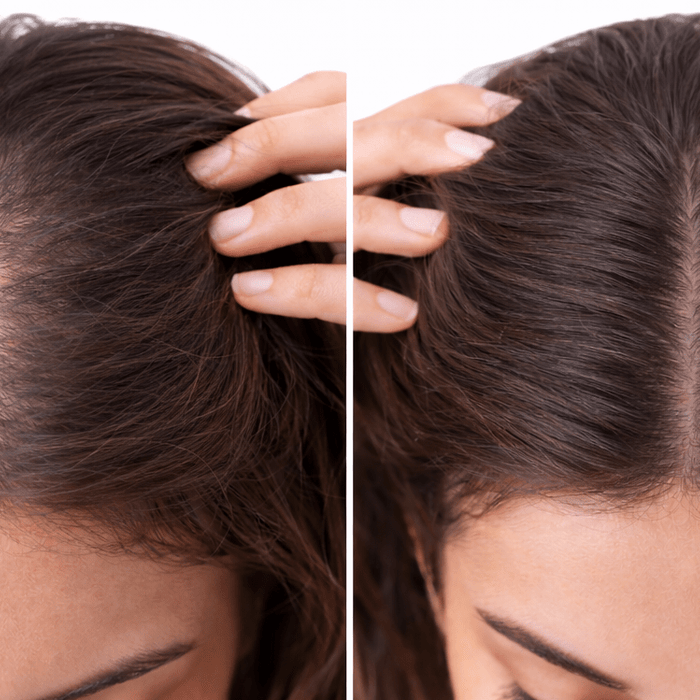 What Causes Hair Thinning in Women Aged 18–35? - Cavinkart
