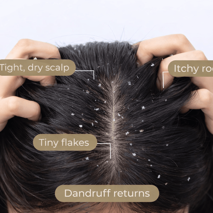 Why Does Dandruff Keep Coming Back Even After Treatment? - Cavinkart